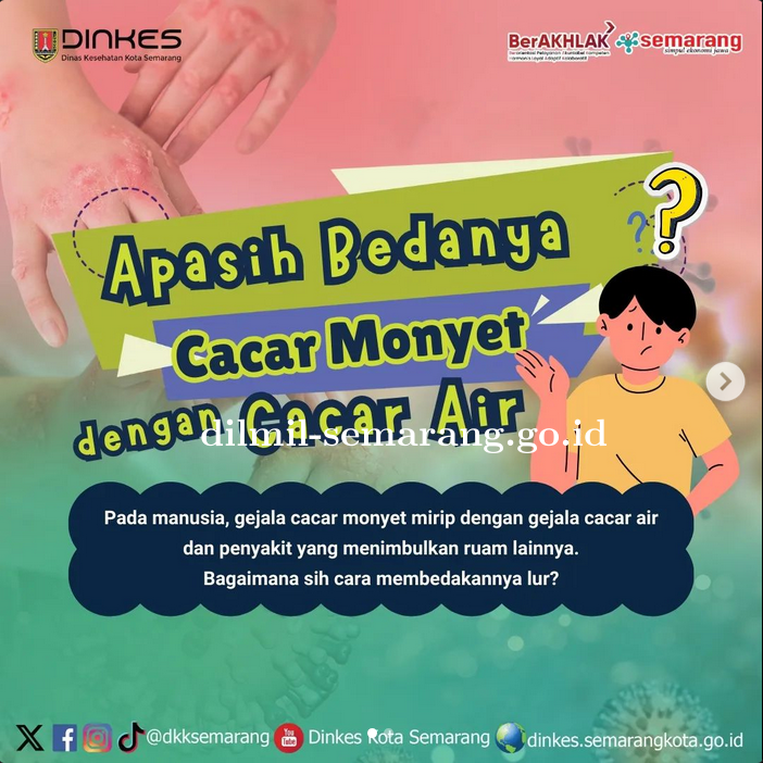 Yuk simak, bedanya Cacar air dan cacar Monyet.